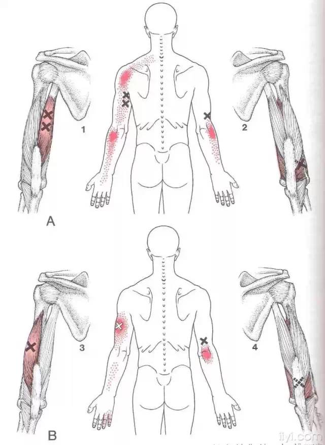 肌筋膜触发点详细图谱建议收藏
