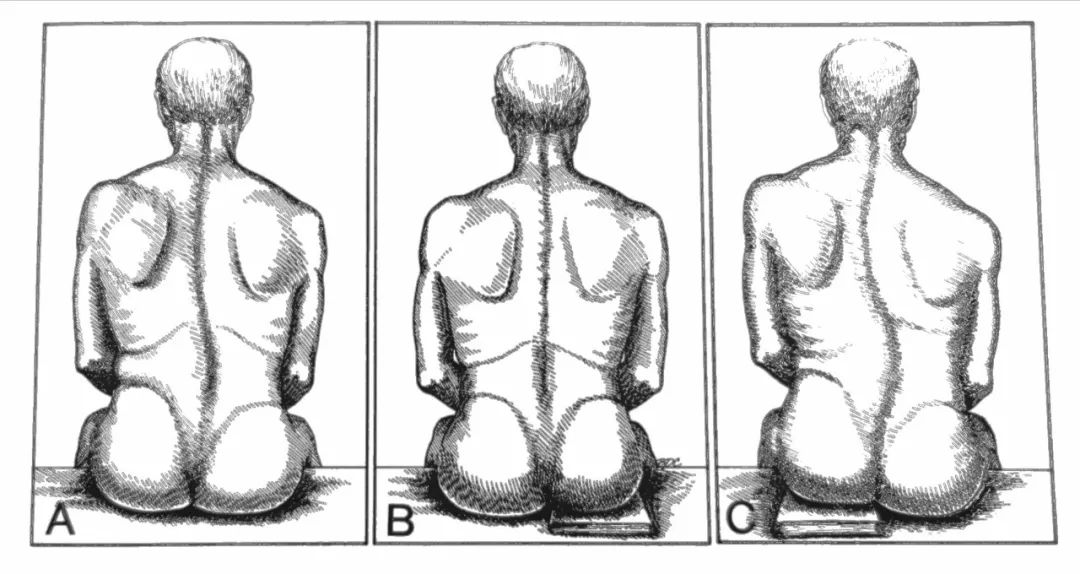 骨盆人口右倾斜经_骨盆倾斜图片(2)