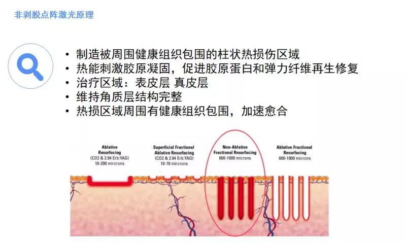 咨询体系非剥脱点阵激光的特点和应用