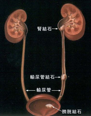 【美年观点】 补钙过度会导致肾结石?