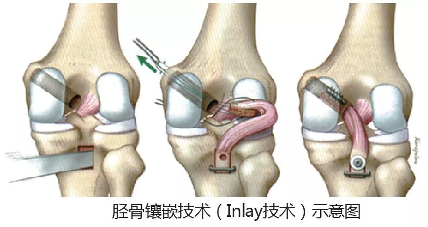 胫骨镶嵌技术 让膝关节韧带 重获新生