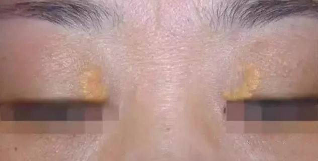出现睑黄疣,建议尽快就诊,并检查血脂指标,评估心血管疾病风险.