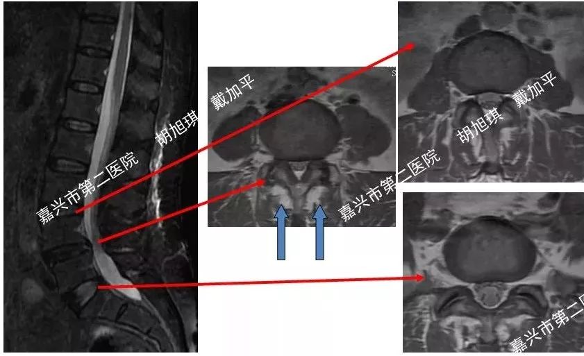 各个层面肌肉退变;l4/5椎间盘突出,椎管狭窄明显;l3/4,l5/s1椎间盘