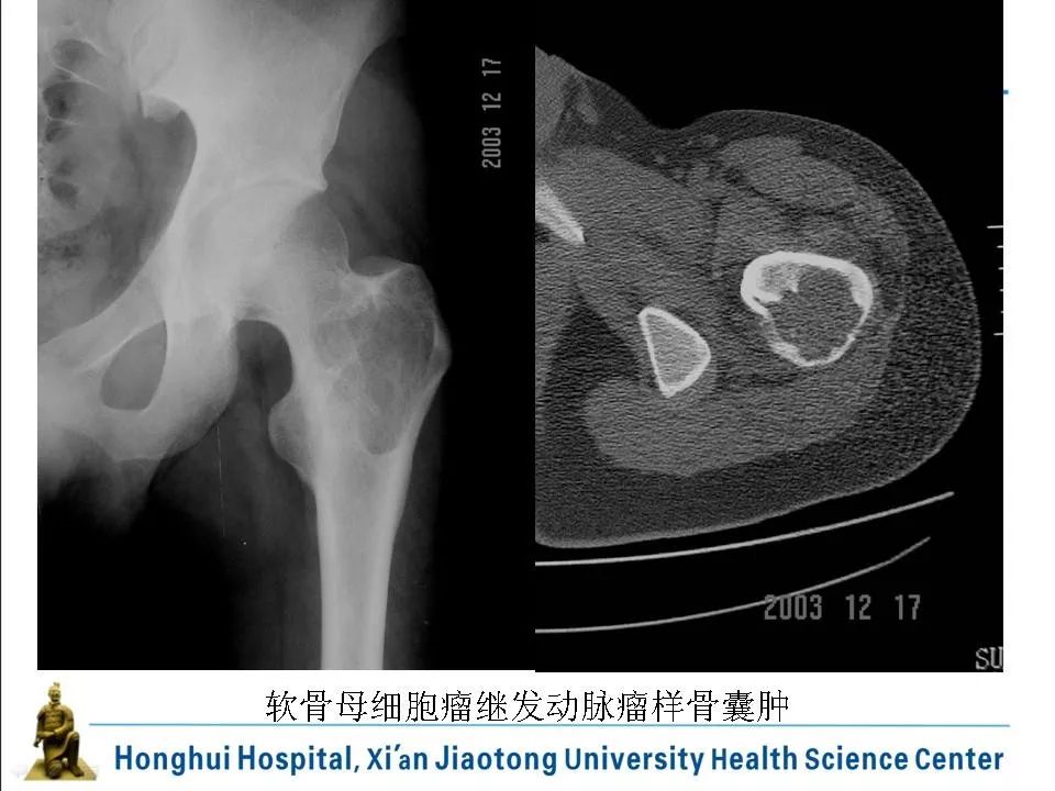 软骨母细胞瘤影像诊断与鉴别诊断丨影像天地