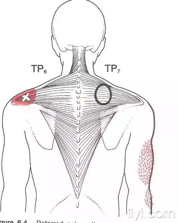 肌筋膜触发点详细图谱建议收藏