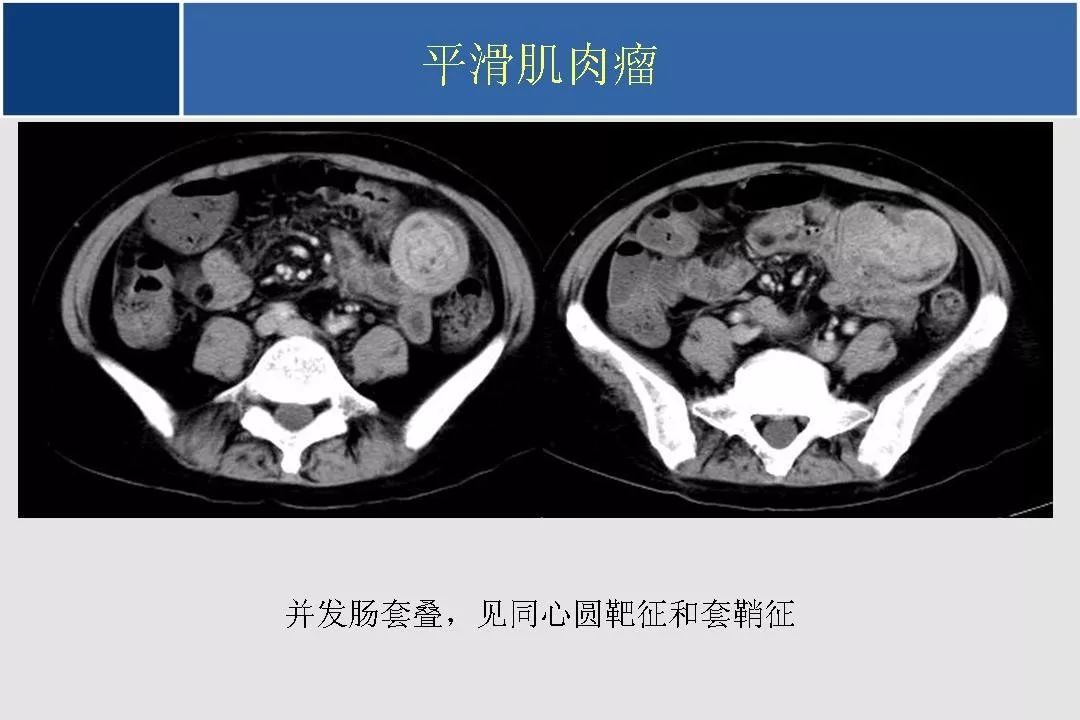 小肠的ctmr影像诊断及进展丨影像天地