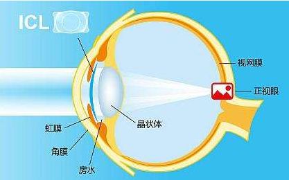 全飞秒近视手术的原理_全飞秒