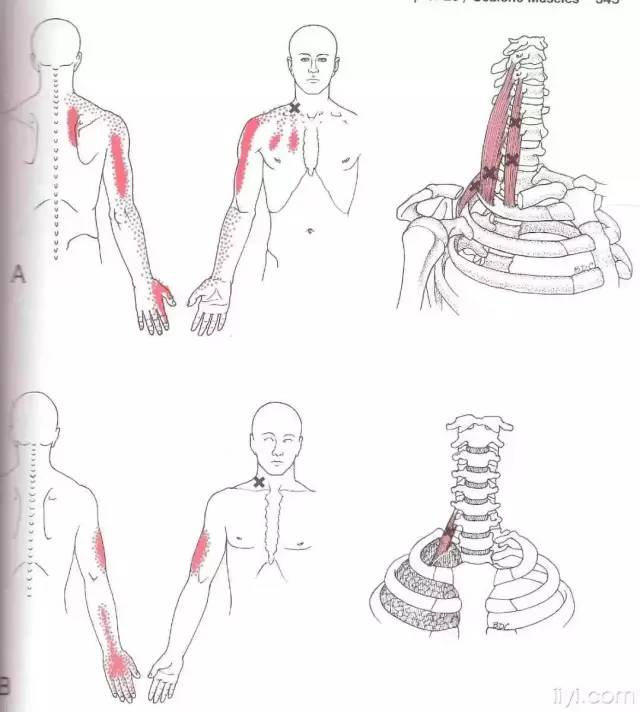 肌筋膜触发点详细图谱建议收藏