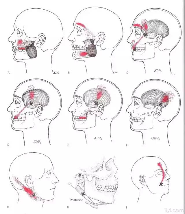 肌筋膜触发点详细图谱建议收藏