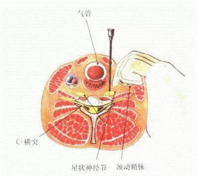 【杏林春暖】治疗椎动脉型颈椎病 星状神经节阻滞术"显神通"
