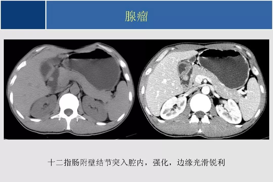 小肠的ctmr影像诊断及进展丨影像天地