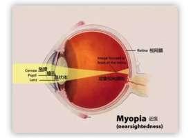 中国近视人口_护眼系列 四 孩子视力差,父母是罪魁(2)