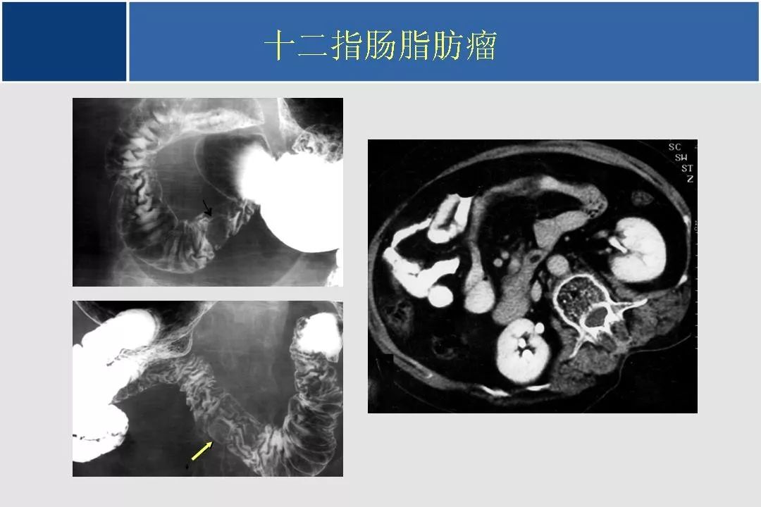 小肠的ctmr影像诊断及进展丨影像天地