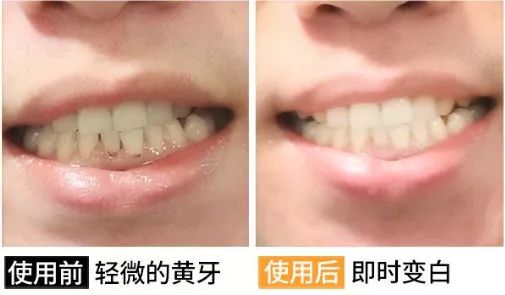 如何正确刷牙让牙齿变白 50f7a88b7c2c4267b46e6c96eabecfd8.jpeg