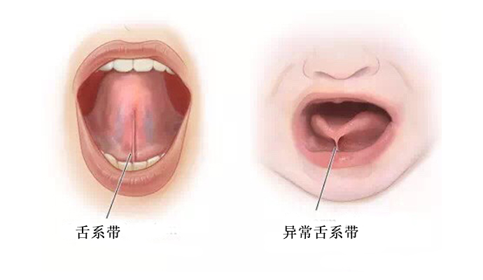 舌头短说话不清楚怎么办