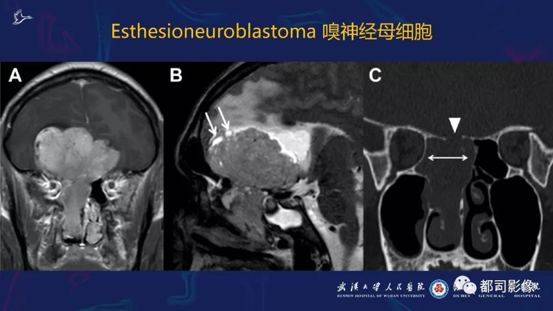 嗅神经母细胞瘤影像诊断