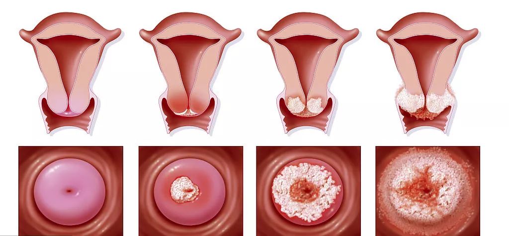 宫颈糜烂不是病,病变起来要你命,不要忽视!