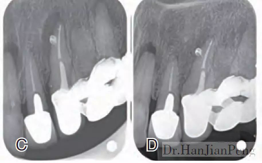 拟行根管治疗后桩冠修复,根管充填后可见近中侧支根管,术后6个月复查