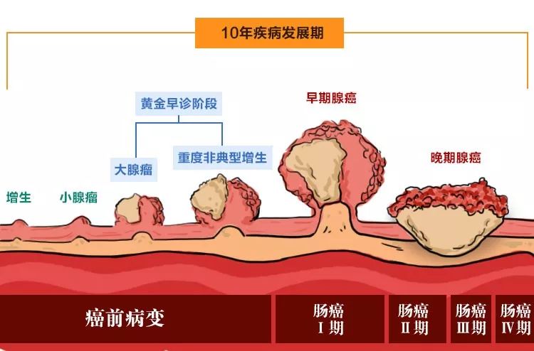 95%的大肠癌是由腺瘤性息肉一步步演变而来的,这个过程需要5-10年的