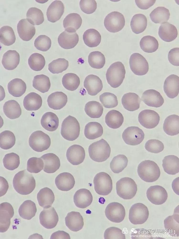 发热待查的喀麦隆归者_疟原虫