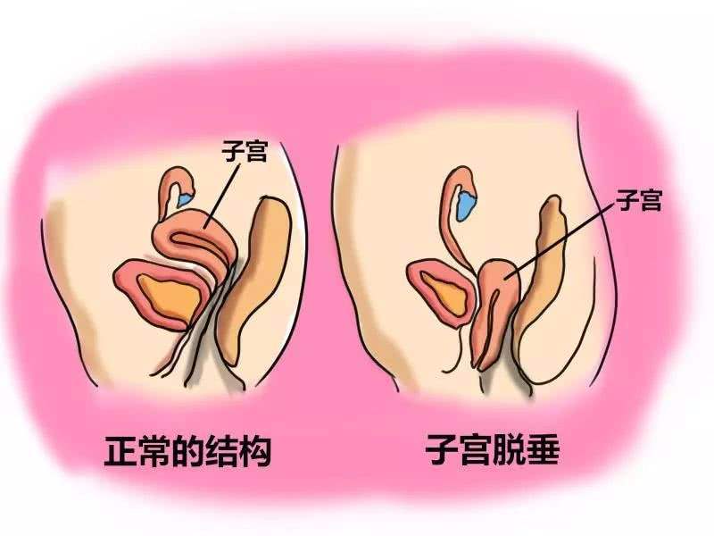 2,预防子宫脱垂