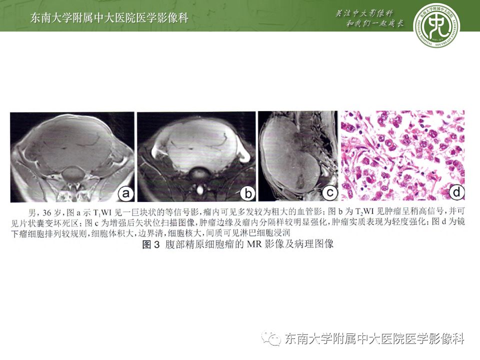 病例结果：睾丸混合性生殖细胞肿瘤 编辑/校对：郑孝飞 增强 ct 因“发现右侧睾丸占位一年”入院返回