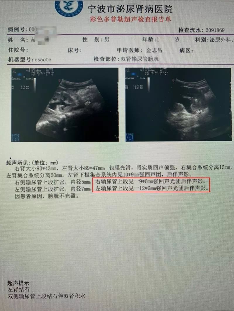 罕见!18个月大的宝宝肾脏,膀胱里长了不少结石,出现急性肾衰