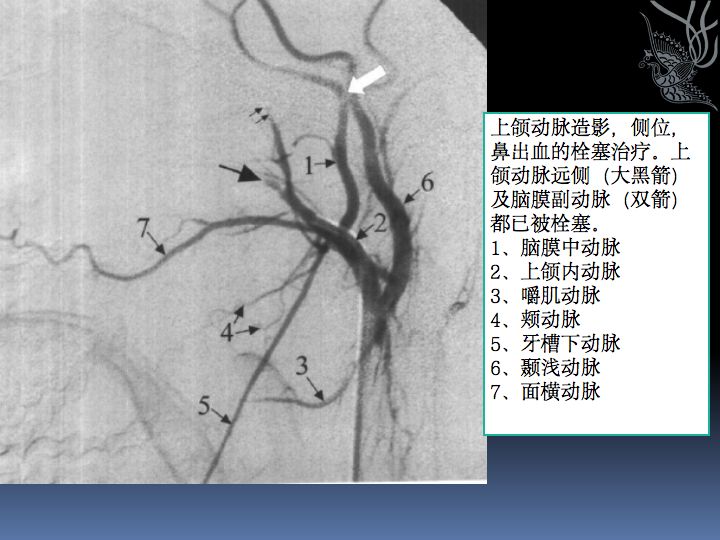 神经解剖| 脑及颈部血管造影图谱