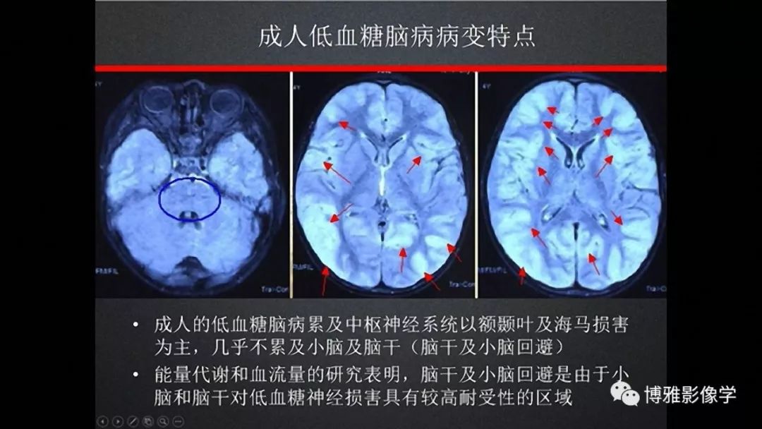 临影结合看图识病之大脑皮层病变