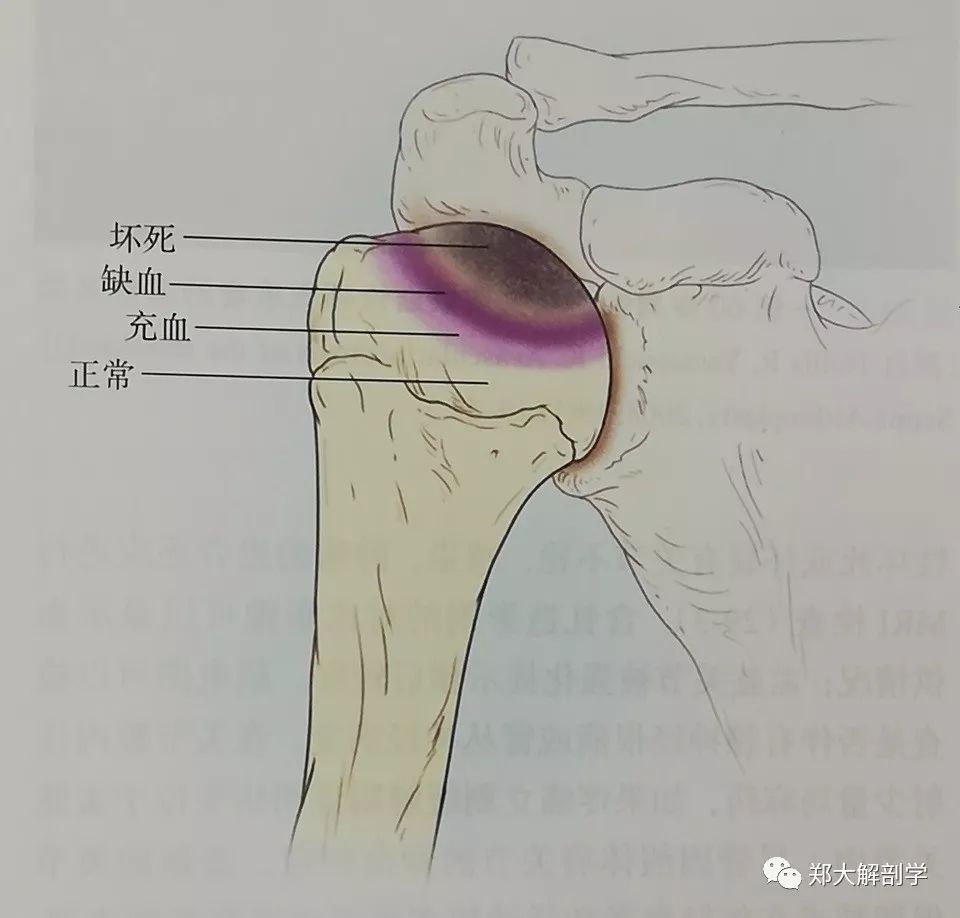 盂肱关节缺血性坏死的疼痛会因主动或被动的活动而加重盂肱关节缺血性