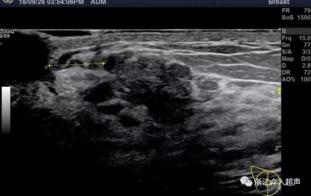 3cm的低回声结节,呈分叶状,距离乳头0.9cm,距离皮肤0.2cm.