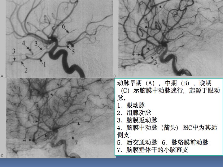 神经解剖| 脑及颈部血管造影图谱