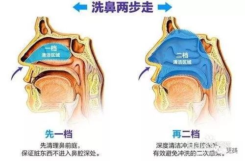 其实,清洁鼻孔有更卫生的方法:可用生理盐水清理鼻腔,一天或者两天