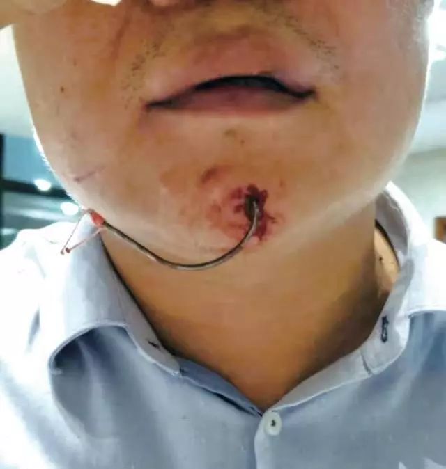 男子夜钓,一竿甩下去,10厘米长大鱼钩"钓"住了自己的下嘴唇,两名医生