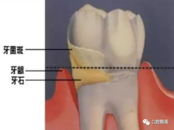 牙结石为什么会长在牙龈下面?_牙齿