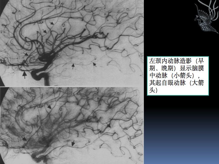 神经解剖| 脑及颈部血管造影图谱