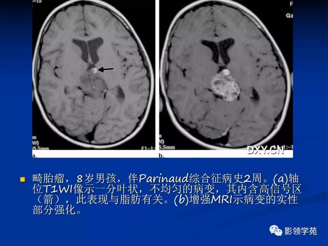 松果体区病变的影像-病理对照