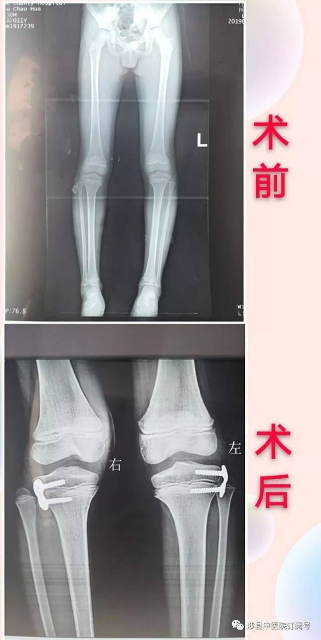 查体:双膝膝关节轻度内翻,平卧位双侧股骨内髁间距约2.