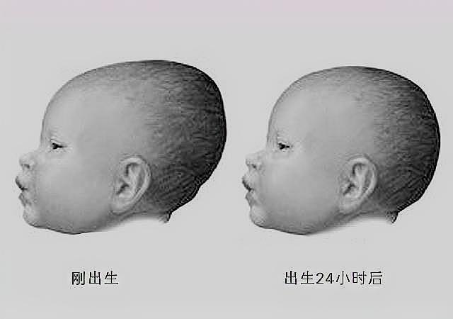                     宝宝的囟门很重要，一岁内时，若囟门出现这3种形态，别大意