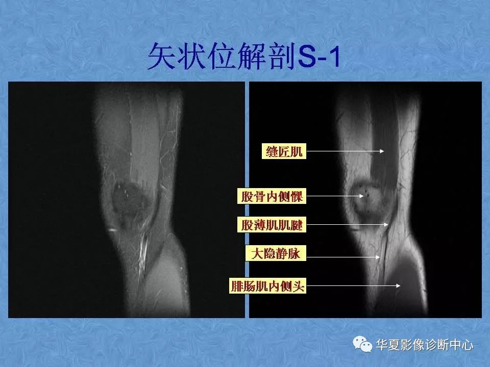 膝关节高清mri解剖