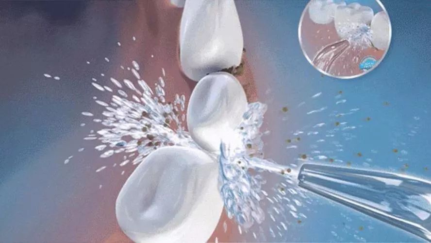 口腔结石怎么彻底清除 9a79c62be1bd4489b7795e59e3624bf7.jpeg