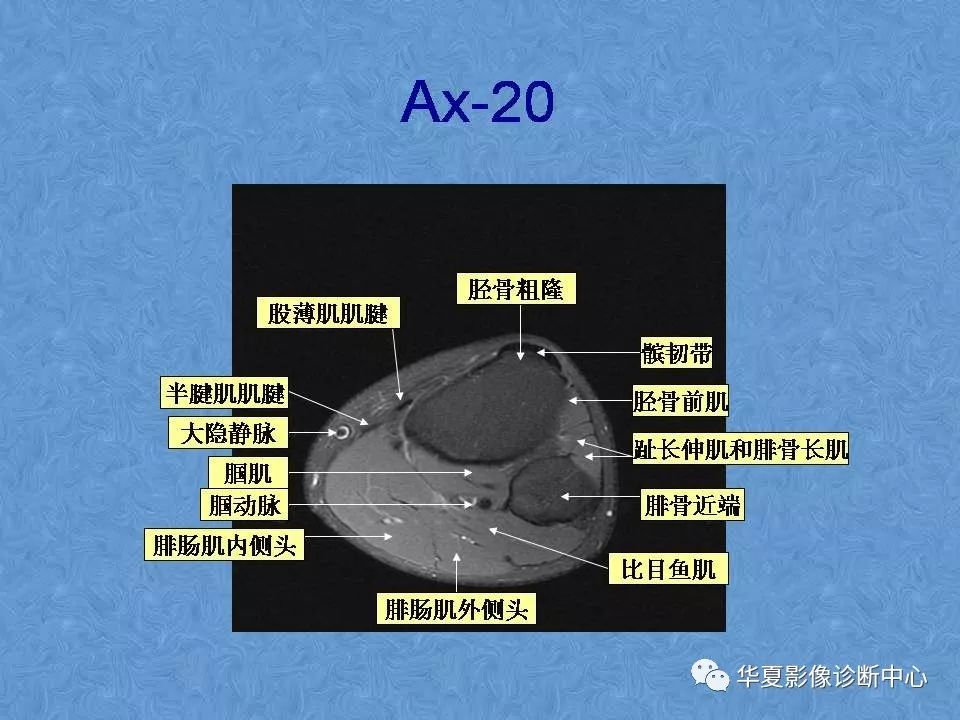 膝关节高清mri解剖