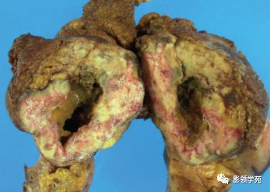 胃肠道淋巴瘤影像学表现