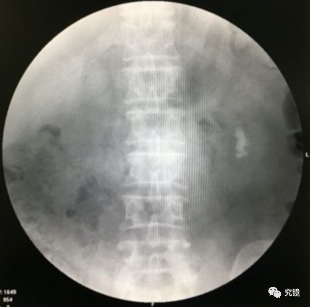 影像学检查:入院时查血常规:白细胞7.00*109/l,中性粒细胞百分比50.