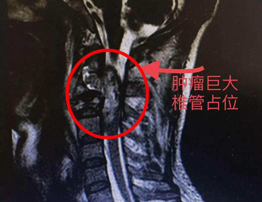 仁医新术丨江西省人民医院开展一例高难度罕见颈椎巨大肿瘤切除术