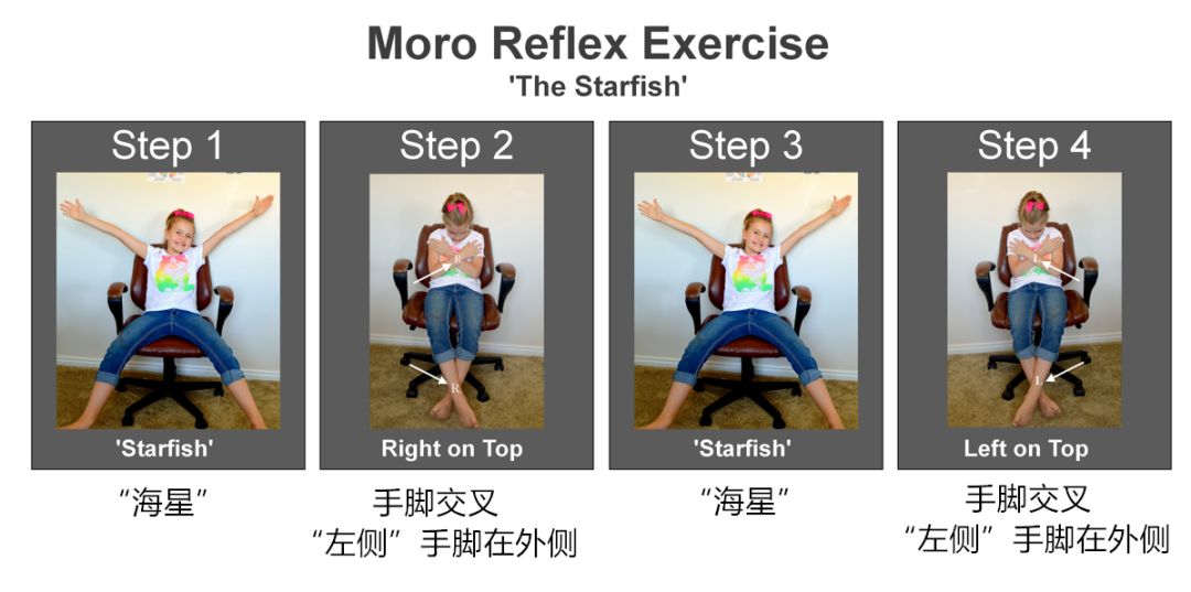 莫洛反射﹙moro reflexw·对碰触,声音及光纤的刺激过度敏感·出现