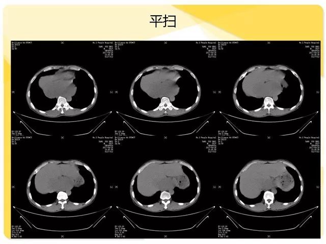 异位胸腺瘤,等你分析丨读片专栏1184期