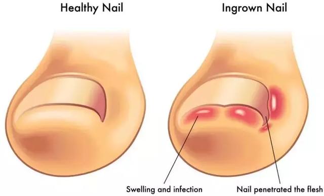脚趾甲肿痒怎么办
