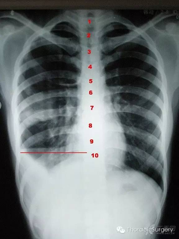 胸腔体表定位及胸腔积液量评估