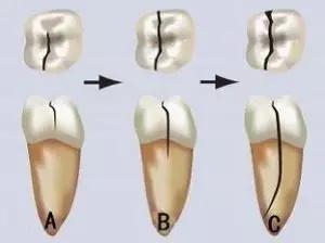 牙裂缝怎么办